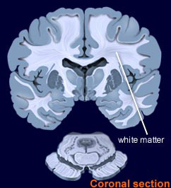 Coronal slice showing white matter